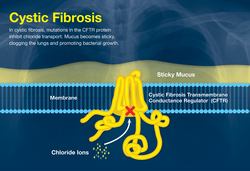 Visual explanation of how cystic fibrosis affects the lungs.